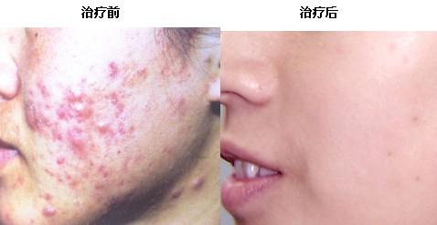 痤疮治疗成功案例前后对比图