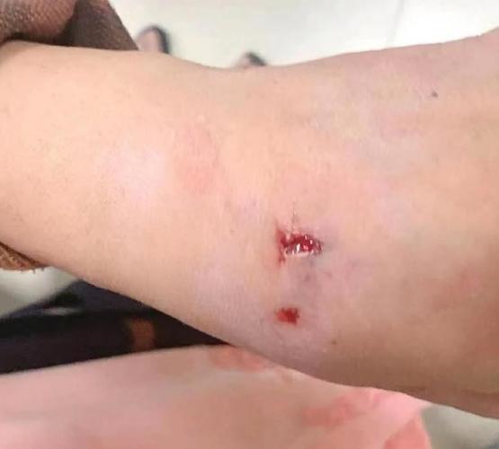(图为如皋被狗咬伤伤者伤口,配图为网络图片,如有侵权请联系删除)