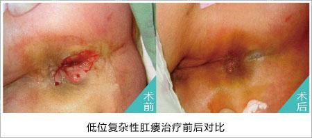 hcpt微创术治肛瘘前后对比图