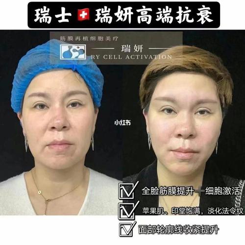 瑞士瑞妍筋膜再植提升效果多久见效_瑞妍怎么样_见效