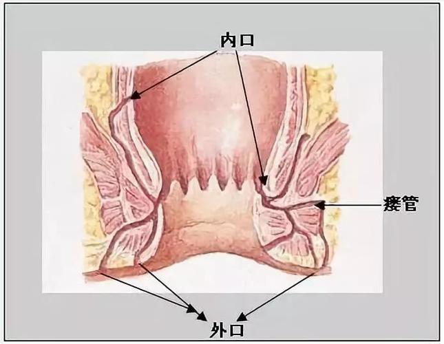 肛瘘为什么总是反反复复?