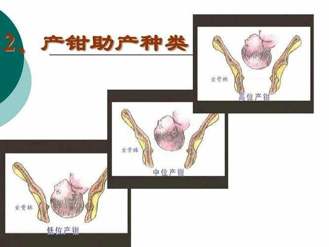 降低剖宫产率的制度和措施