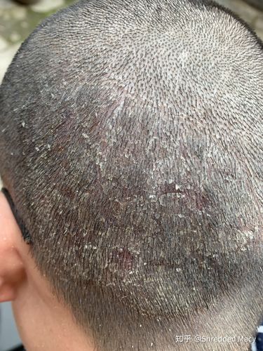 经验帖:我是如何治疗头皮癣的