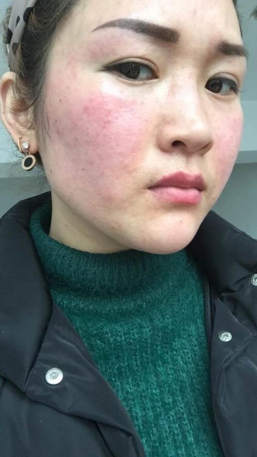 如何解决花粉性过敏