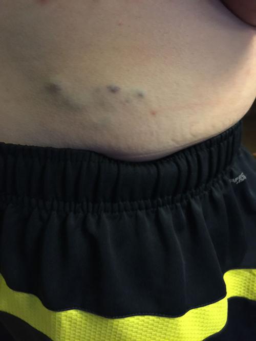 15岁男孩腰上部位青的,是不是血管瘤,怎么办