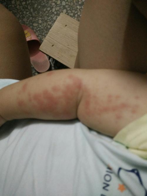 宝宝手臂上长红斑点是不是过敏?大家帮我看一下,宝宝手上长的是什么?