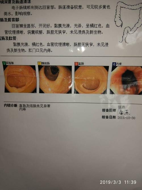 痔疮会便秘,下坠和大便形形改变吗?