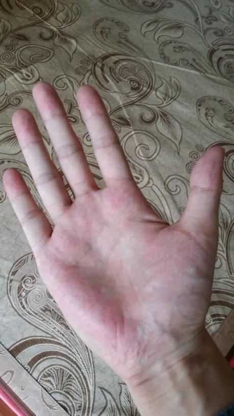 肝掌图片_360图片