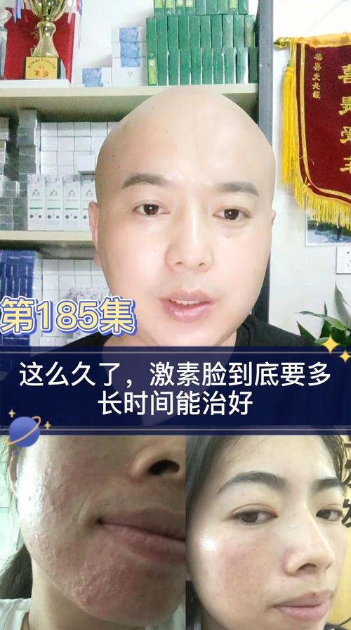 都这么久了,激素脸到底要多长时间能治好_激素性_皮炎