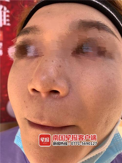随着时间的推移,杨某以为鼻子的疤痕会逐渐消失,不料鼻小柱部分的