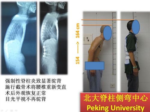 脊柱侧弯典型病例-脊柱后凸(驼背)