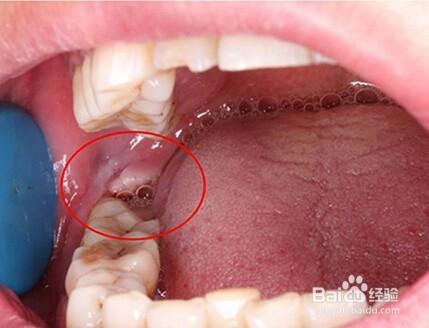 长智齿时,疼痛难忍,怎么办?