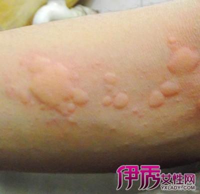 【图】风湿疙瘩的治疗方法与偏方 预防风湿疙瘩的注意事项