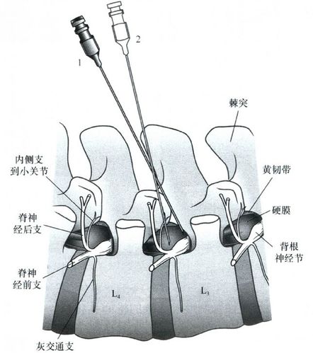 麻醉和疼痛介入治疗图谱》——脊柱注射技术:经椎间孔选择性神经根