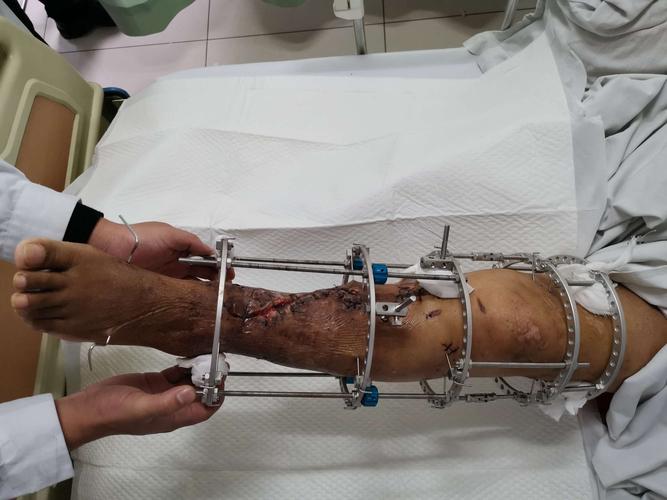 左小腿开放骨折术后感染一例