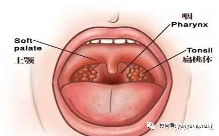 怎么区分咽炎和扁桃体炎三步教你分辨