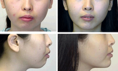 隆下巴手术前后对比图