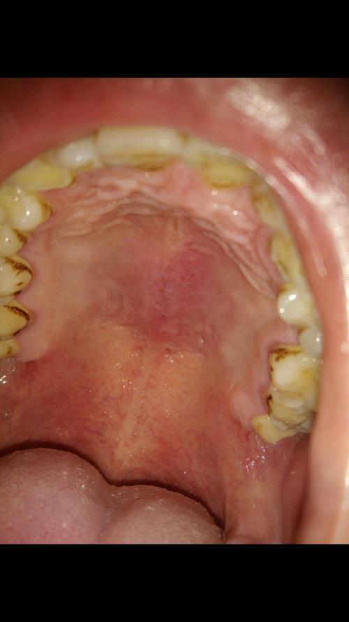 早上起床口腔上颚不对劲 用舌头碰的时候疼 照了张照片这样 这是什么