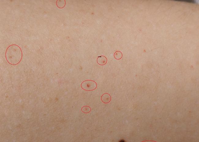 有一种红点可不一定都是这些造成的,而是病毒感染而引起的.