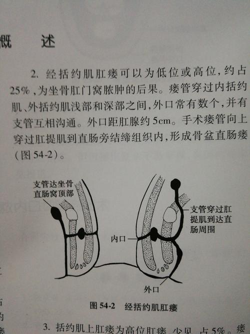 普外二科之 肛瘘科普知识