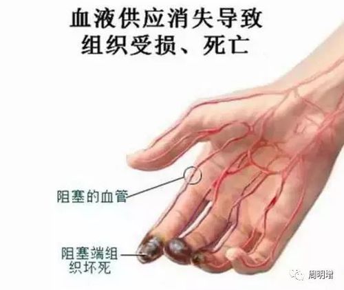 血管闭塞性脉管炎_顾步汤