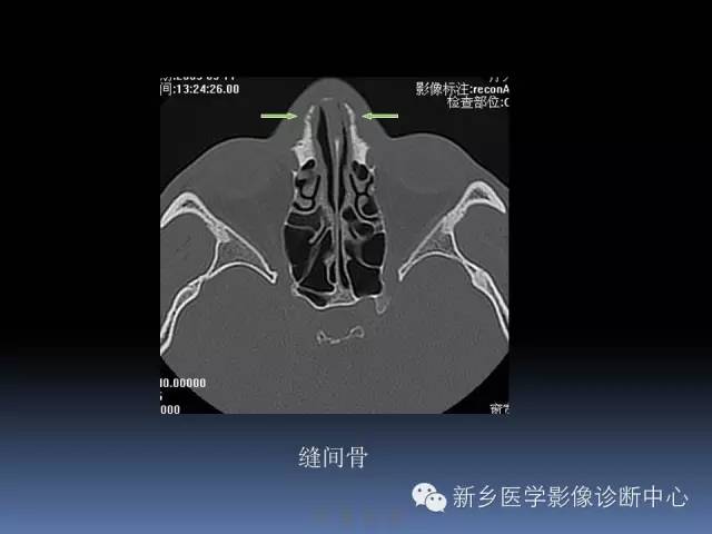 写鼻骨骨折ct报告,一定要了解的解剖