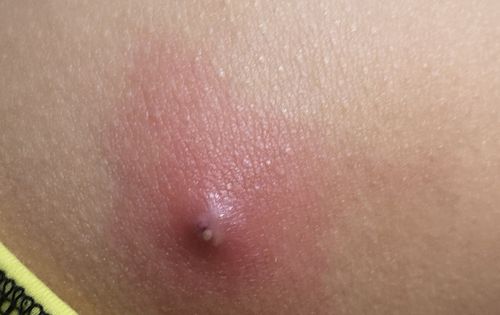 屁股蛋上长了个包 挺疼的 周围红红的 大概是这样