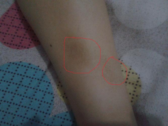 女生小腿上有淤青似的东西,求救是什么?怎么去除