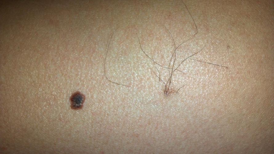 年轻白领皮肤异常没在意却被确诊艾滋病险些错过最佳治疗期