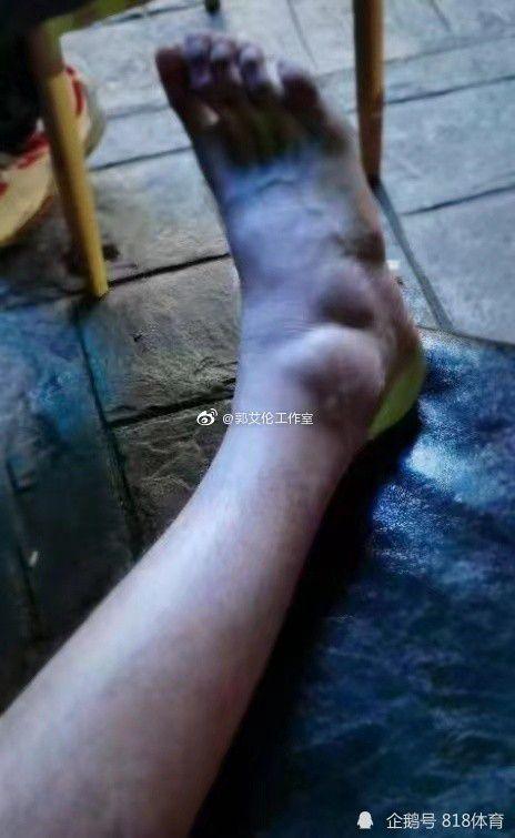 肿胀的手指和脚踝,只见他的右脚上有两个巨大的肿块,一看就是积水情况