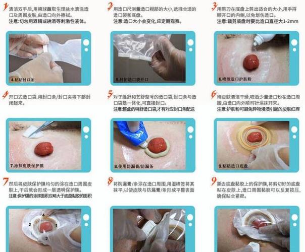 结肠造口术是外科中常见的手术,分为临时性造口和永久性人工肛门
