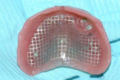 胶托铸网活动义齿