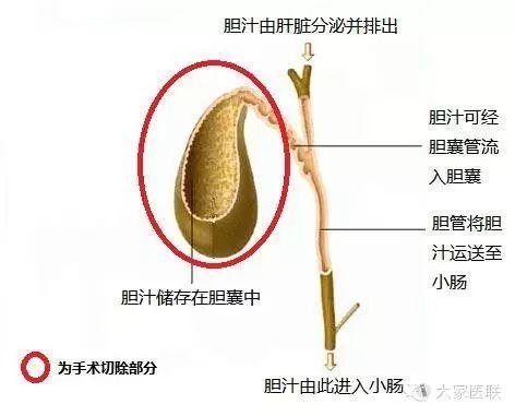 红圈为切除部分,切除后并不影响胆汁的排出,对消化影响甚小