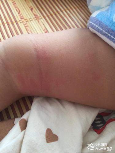 腿上的 红红的 上星期验血说牛奶过敏 牛肉不能吃