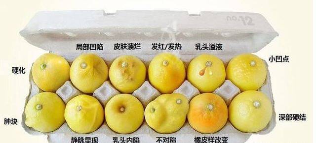 在乳房上出现类似于酒窝一样的表现,就一定要提高警惕了.