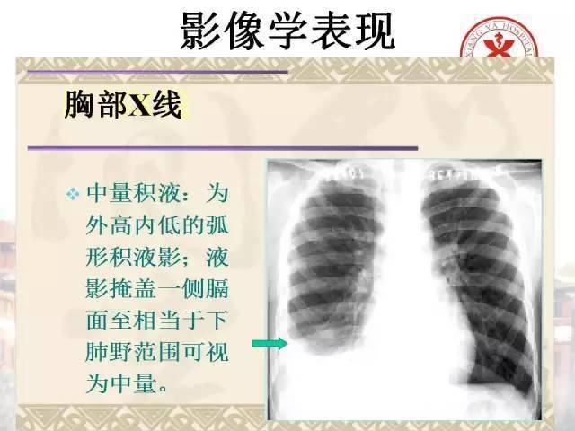 经典胸腔积液的影像学表现