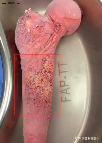 把骨头煮熟,冷冻后再放回去:这种方法治疗骨癌,靠谱吗