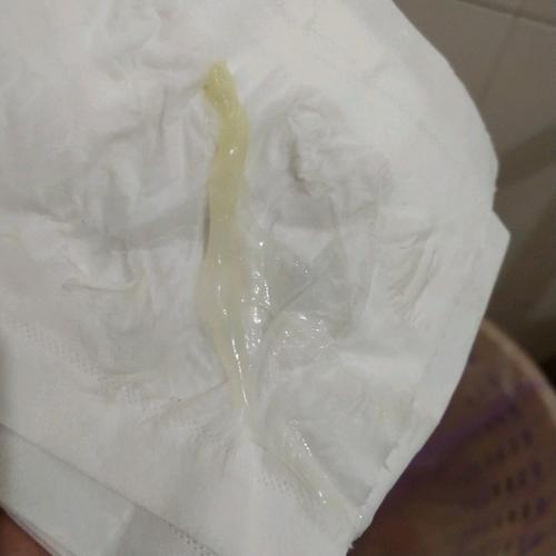 有一样到孕晚期白带特别多的吗!我这个看样子是不是有点炎症啊?