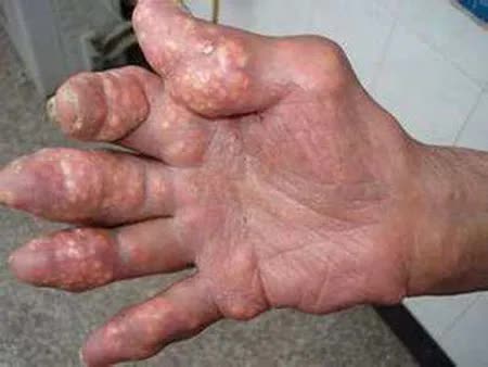 有些痛风的病友,起初两次急性发作期间隔几年以上,逐渐的出现了一年几