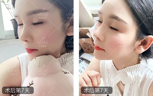 柳儿综合隆鼻 北京美莱鼻部案例