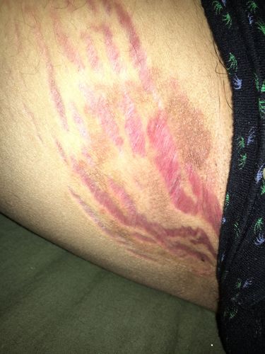 大腿内侧的 请问这个是不是肥胖纹