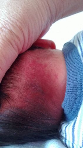 请问这是血管瘤么,貌似不突起,按压不退色