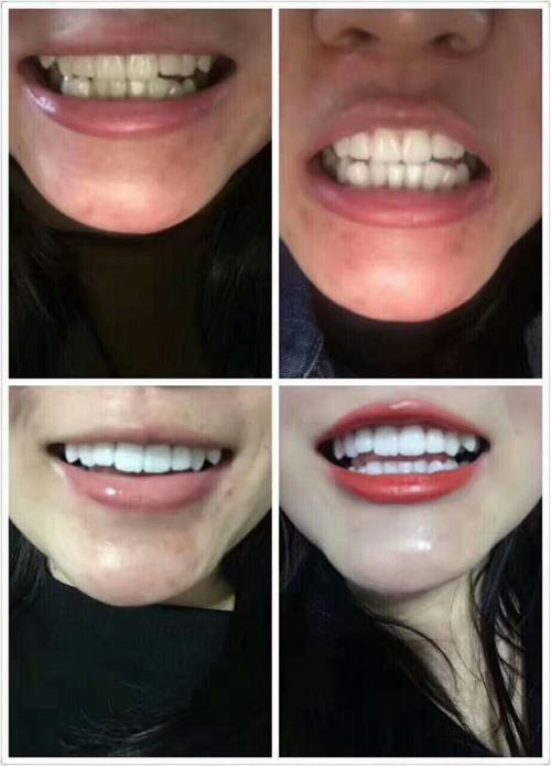 牙齿白白才好看 卫星mibao705