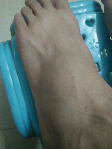 可以用绷带或宽胶布将患侧足踝背伸90后轻度外翻位包扎固定,限制行走