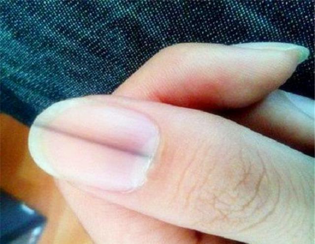 原创指甲有黑线,是什么原因造成的?你的理解真的正确吗?看专家理解