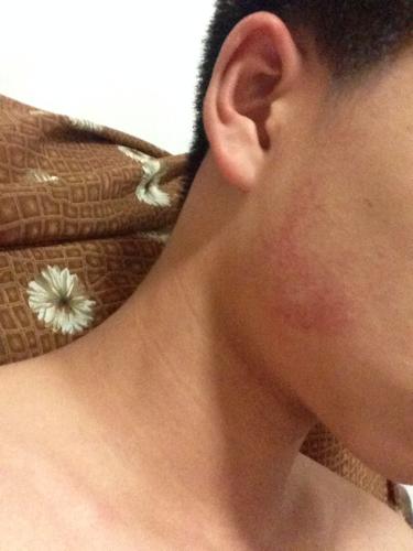 09:35    浏览  33333  满意回答 这个是颜面部红斑毛囊角化病,这个多