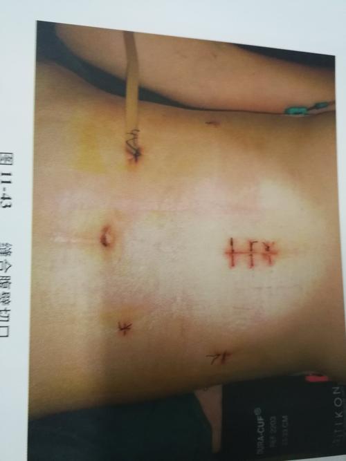 目前绝大部分胃癌根治术都是d2清扫,淋巴结在手术的相关区域一并清扫