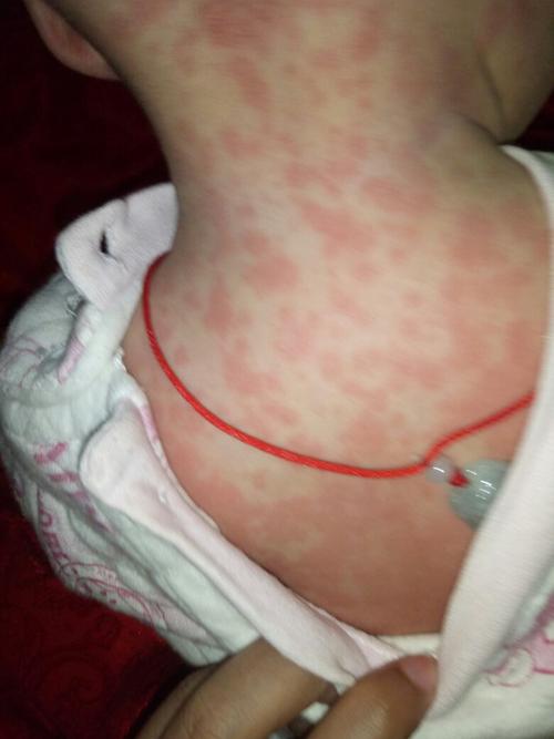 我宝宝是前几天发烧去医院看,医生说退烧后会全身长红点,是这样吗?