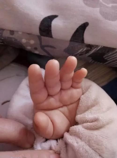 1,断掌纹与唐氏宝宝有什么关系?