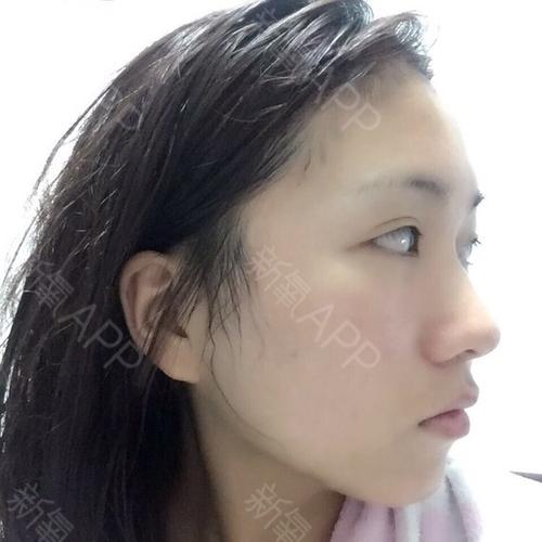 鼻骨宽,所以看起来五官一点都不精致,特别希望鼻子能精致一点,显得